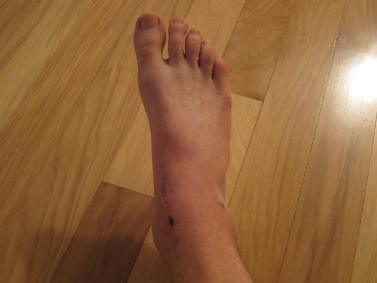 Joseph P. Fisher's ankle scars five weeks from surgery