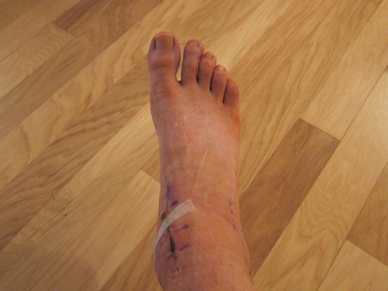 image of Joseph P Fisher's right ankle with surgical scars