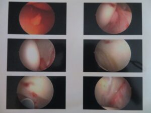 first series of six arthroscopic photos of Joe Fisher's right hip cartilage damage prior to surgical repair