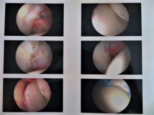second series of arthroscopic photos of Joe Fisher's right hip labral repair detailing the suturing of the torn labrum